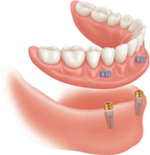 implantater undermund